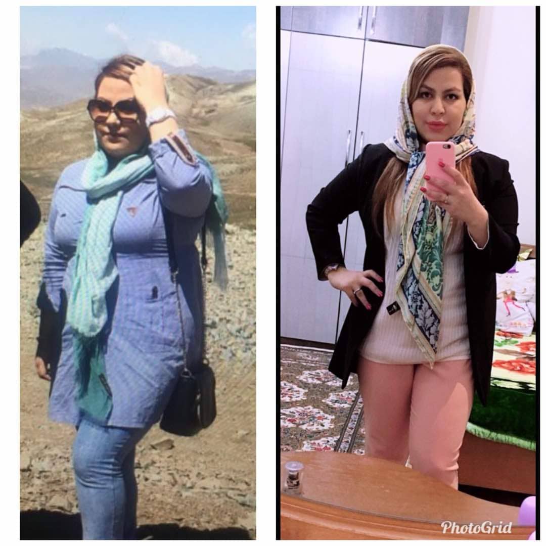 قبل و بعد از عمل