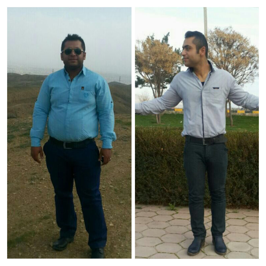 قبل و بعد از عمل