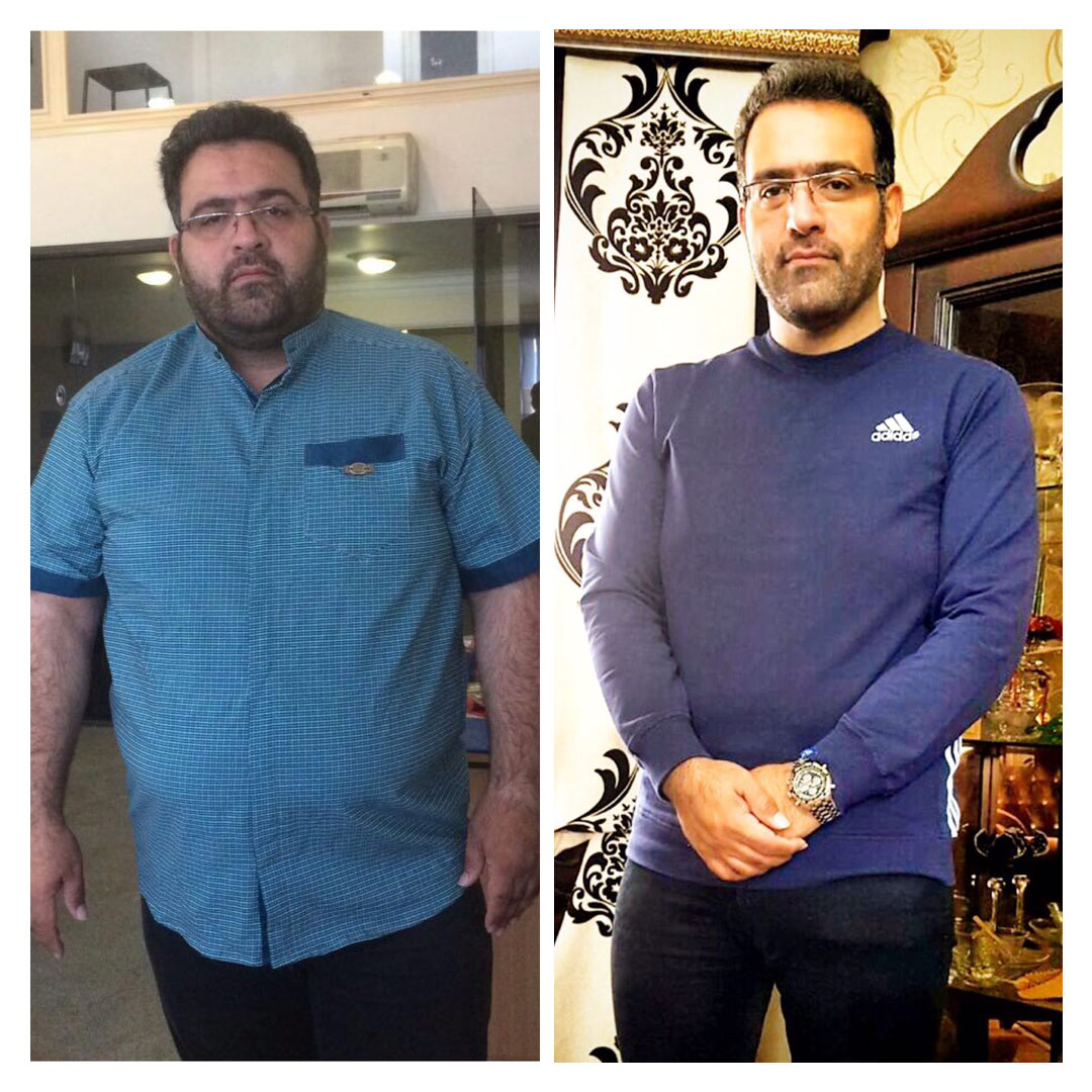 قبل و بعد از عمل