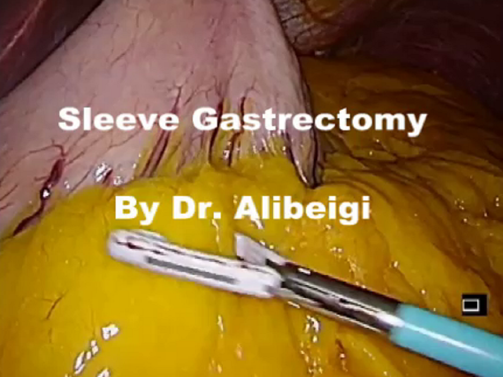 جراحی اسلیو معده توسط دکتر علی بیگی