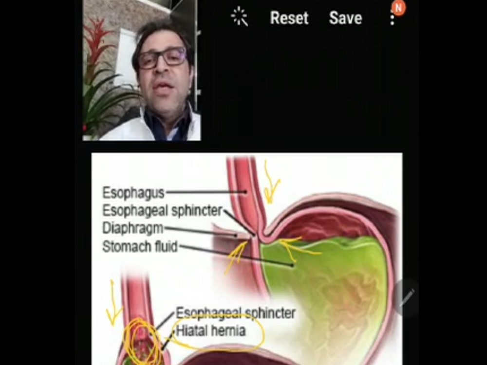 نکاتی درباره رفلاکس معده