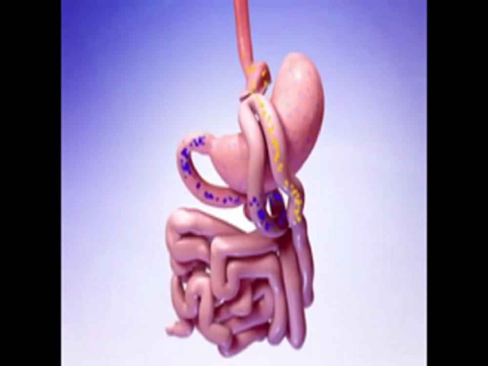 جراحی مینی بای پس معده