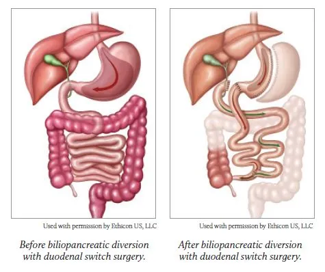 دئودنال سوئیچ (بای پس روده)